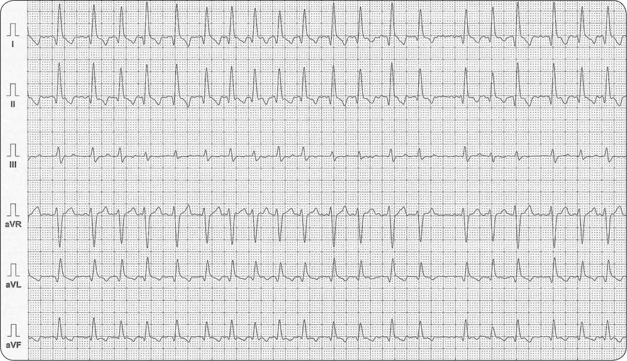 Jakie leki na migotanie przedsionków? Pełny przewodnik dla pacjenta
