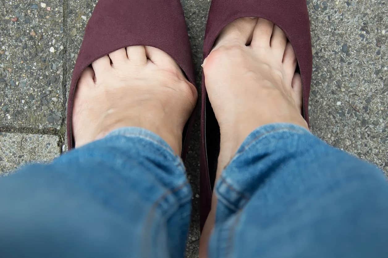 Leczenie haluksów: Od domowych metod po operację. Co wybrać?