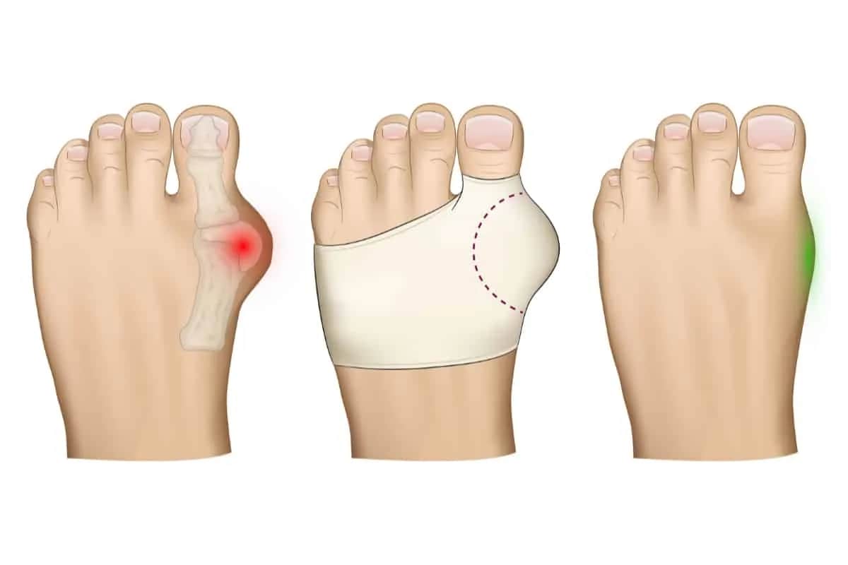 Ból haluksa? Skuteczne metody ulgi i leczenia od domu po operację